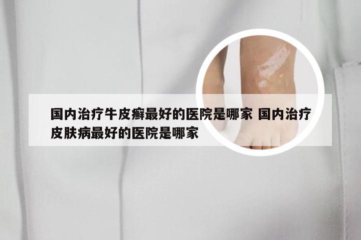 国内治疗牛皮癣最好的医院是哪家 国内治疗皮肤病最好的医院是哪家