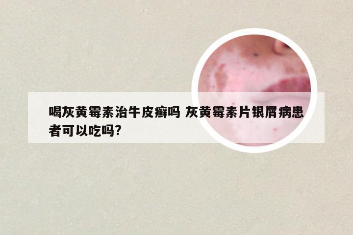 喝灰黄霉素治牛皮癣吗 灰黄霉素片银屑病患者可以吃吗?