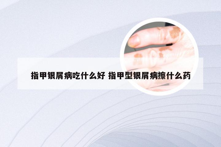 指甲银屑病吃什么好 指甲型银屑病擦什么药