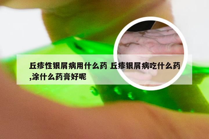 丘疹性银屑病用什么药 丘疹银屑病吃什么药,涂什么药膏好呢