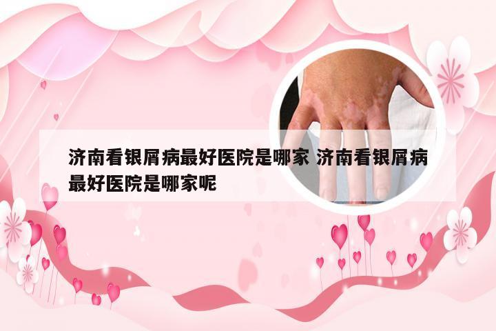 济南看银屑病最好医院是哪家 济南看银屑病最好医院是哪家呢