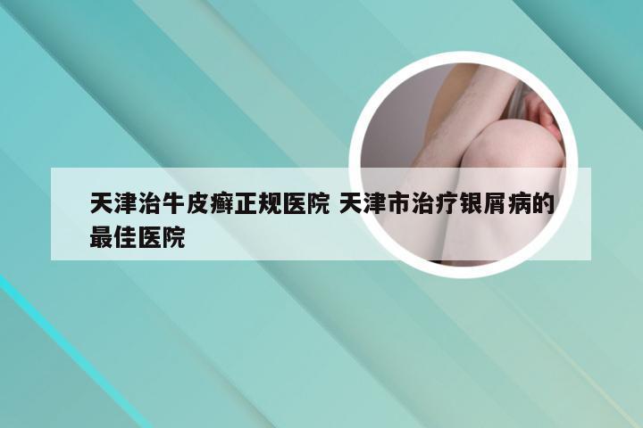 天津治牛皮癣正规医院 天津市治疗银屑病的最佳医院
