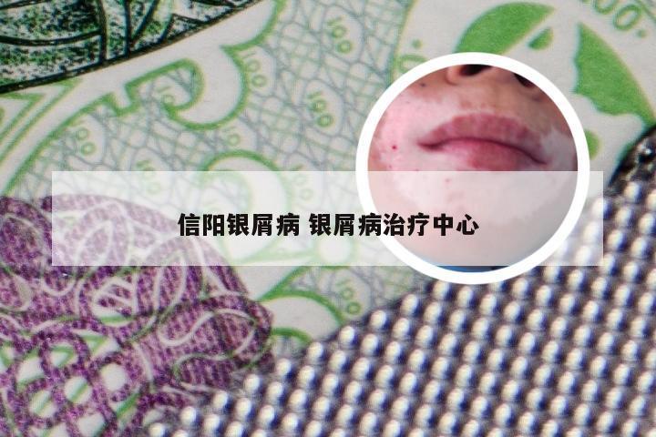 信阳银屑病 银屑病治疗中心