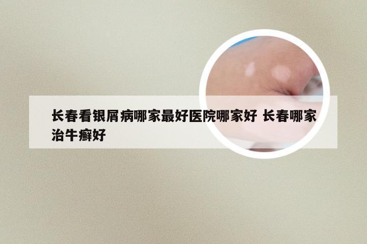 长春看银屑病哪家最好医院哪家好 长春哪家治牛癣好