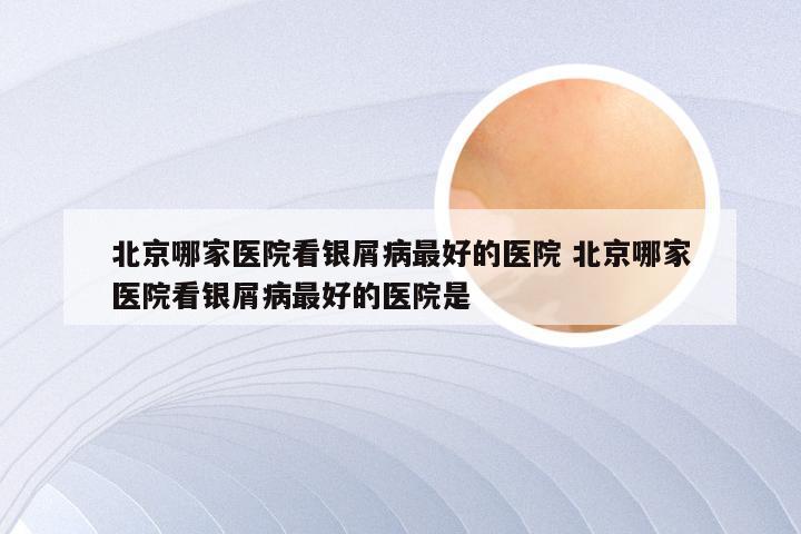 北京哪家医院看银屑病最好的医院 北京哪家医院看银屑病最好的医院是