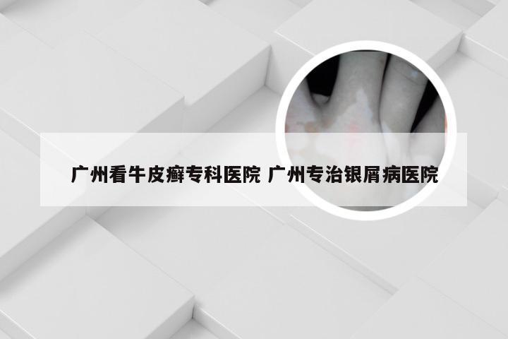 广州看牛皮癣专科医院 广州专治银屑病医院