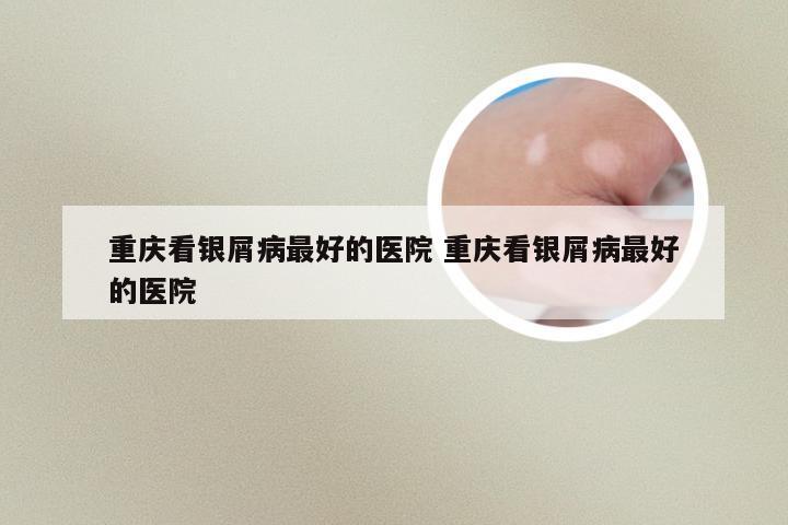 重庆看银屑病最好的医院 重庆看银屑病最好的医院