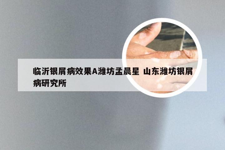 临沂银屑病效果A潍坊孟晨星 山东潍坊银屑病研究所