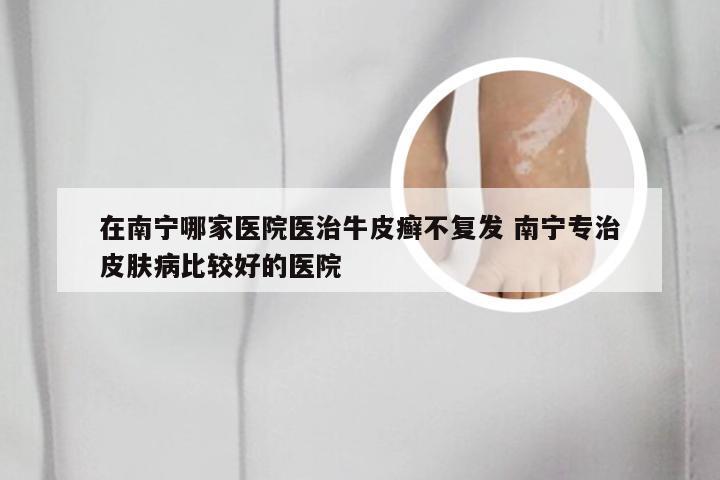 在南宁哪家医院医治牛皮癣不复发 南宁专治皮肤病比较好的医院