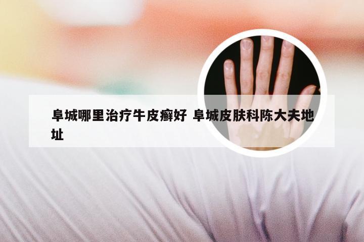 阜城哪里治疗牛皮癣好 阜城皮肤科陈大夫地址