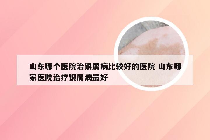 山东哪个医院治银屑病比较好的医院 山东哪家医院治疗银屑病最好
