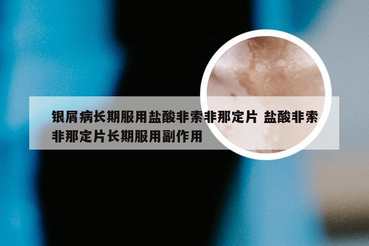 银屑病长期服用盐酸非索非那定片 盐酸非索非那定片长期服用副作用