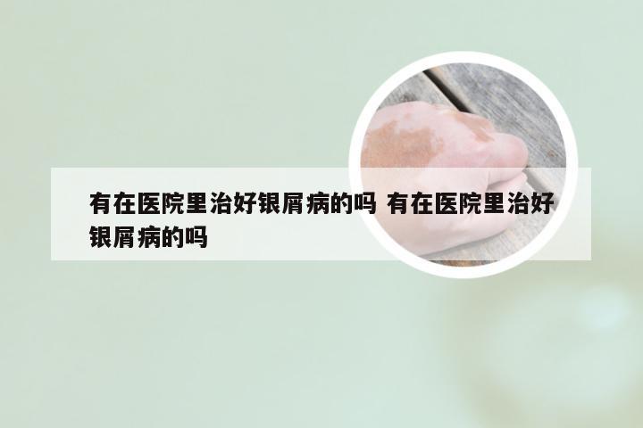 有在医院里治好银屑病的吗 有在医院里治好银屑病的吗
