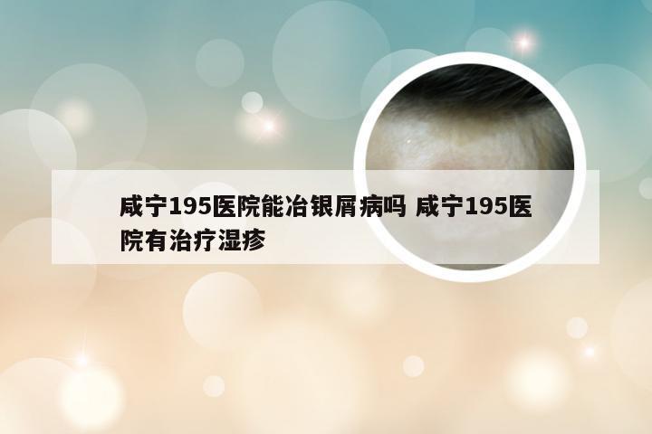 咸宁195医院能冶银屑病吗 咸宁195医院有治疗湿疹