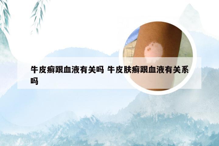 牛皮癣跟血液有关吗 牛皮肤癣跟血液有关系吗