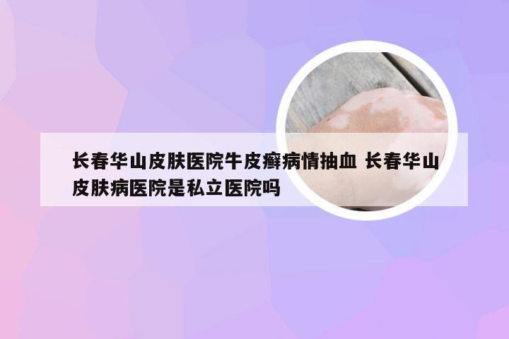长春华山皮肤医院牛皮癣病情抽血 长春华山皮肤病医院是私立医院吗