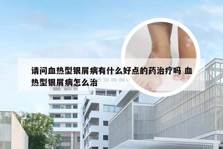 请问血热型银屑病有什么好点的药治疗吗 血热型银屑病怎么治