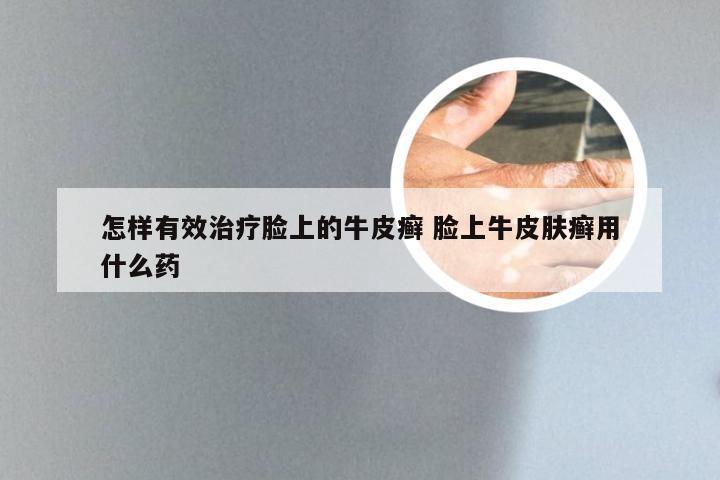 怎样有效治疗脸上的牛皮癣 脸上牛皮肤癣用什么药