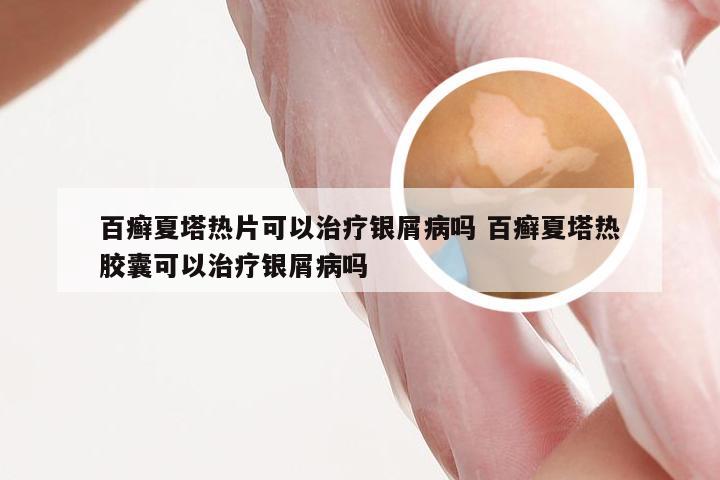 百癣夏塔热片可以治疗银屑病吗 百癣夏塔热胶囊可以治疗银屑病吗