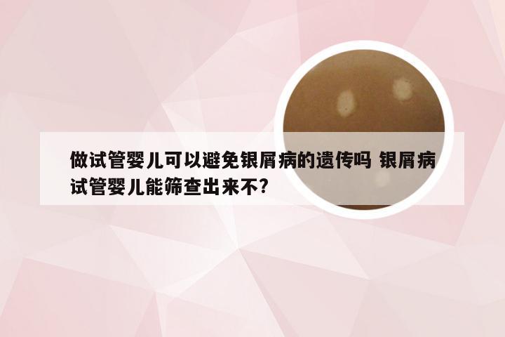 做试管婴儿可以避免银屑病的遗传吗 银屑病试管婴儿能筛查出来不?