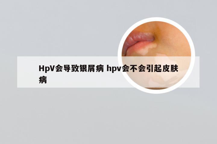 HpV会导致银屑病 hpv会不会引起皮肤病