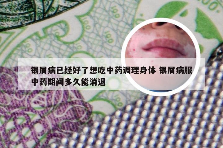 银屑病已经好了想吃中药调理身体 银屑病服中药期间多久能消退