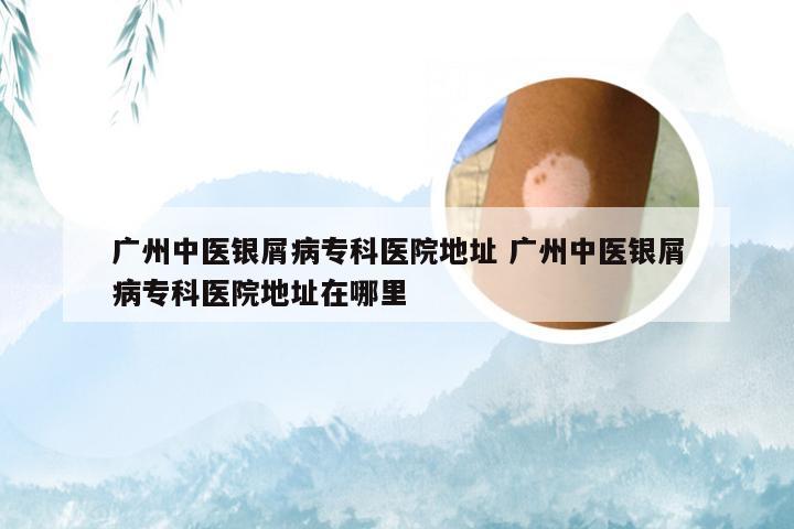 广州中医银屑病专科医院地址 广州中医银屑病专科医院地址在哪里