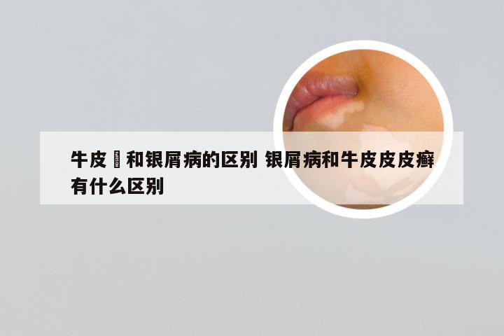 牛皮癬和银屑病的区别 银屑病和牛皮皮皮癣有什么区别