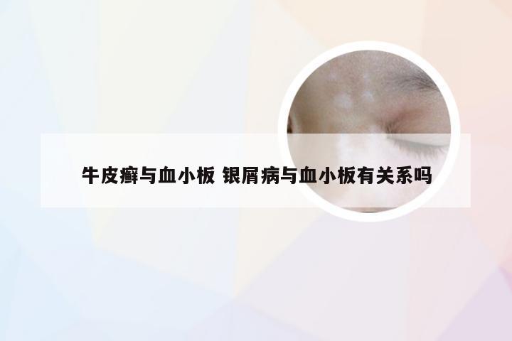 牛皮癣与血小板 银屑病与血小板有关系吗