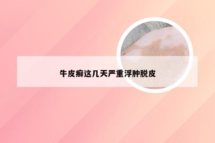 牛皮癣这几天严重浮肿脱皮