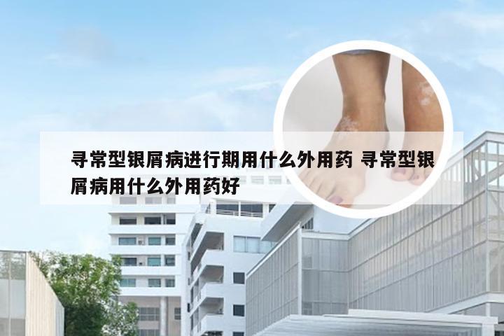 寻常型银屑病进行期用什么外用药 寻常型银屑病用什么外用药好