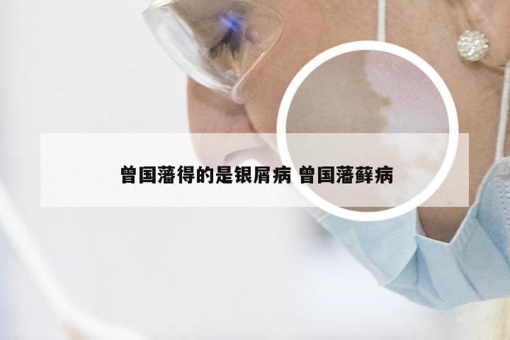 曾国藩得的是银屑病 曾国藩藓病
