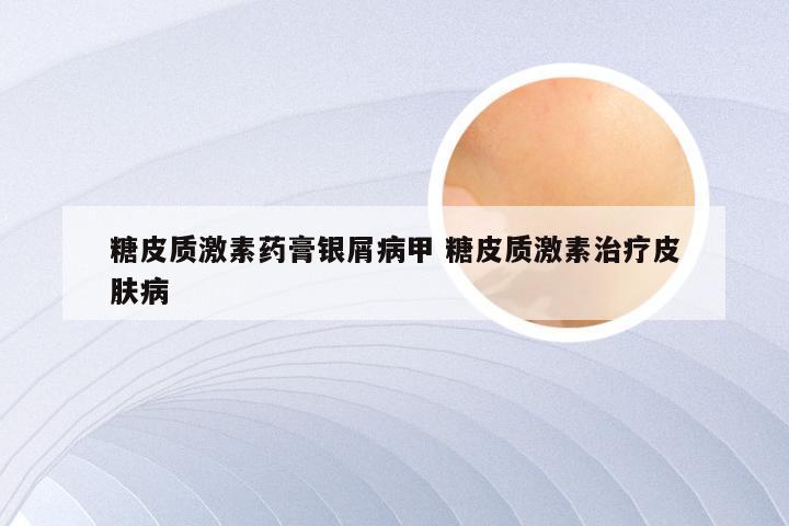 糖皮质激素药膏银屑病甲 糖皮质激素治疗皮肤病