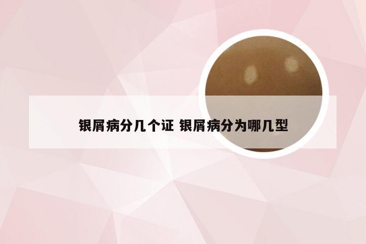 银屑病分几个证 银屑病分为哪几型