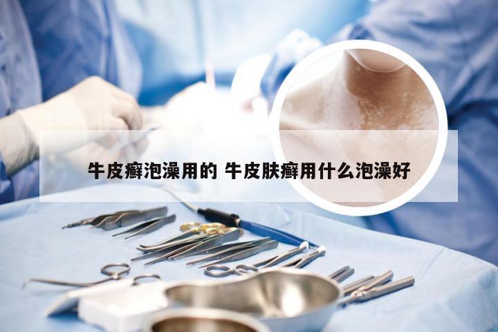 牛皮癣泡澡用的 牛皮肤癣用什么泡澡好