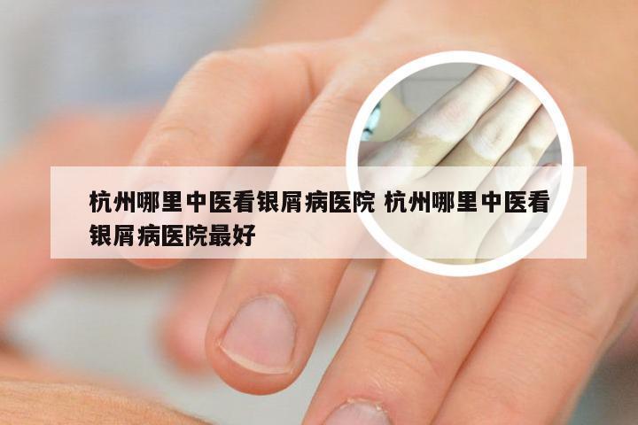 杭州哪里中医看银屑病医院 杭州哪里中医看银屑病医院最好