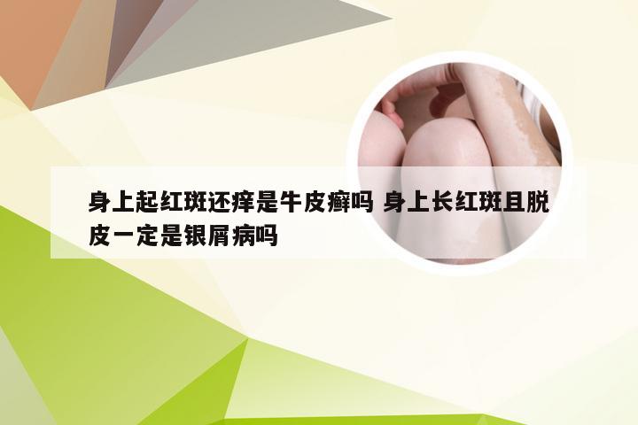 身上起红斑还痒是牛皮癣吗 身上长红斑且脱皮一定是银屑病吗