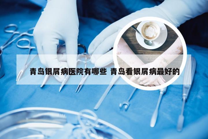青岛银屑病医院有哪些 青岛看银屑病最好的