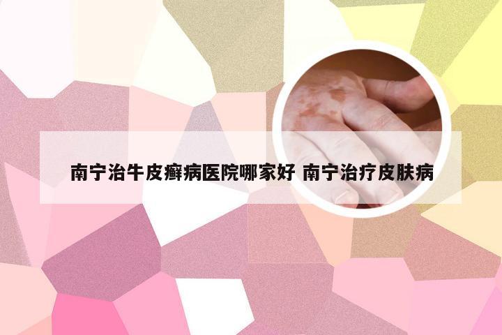 南宁治牛皮癣病医院哪家好 南宁治疗皮肤病
