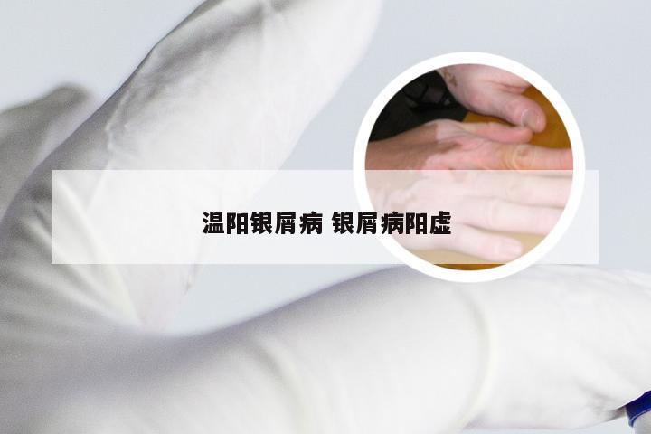 温阳银屑病 银屑病阳虚