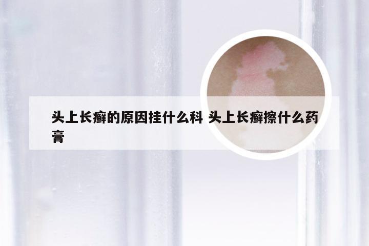 头上长癣的原因挂什么科 头上长癣擦什么药膏