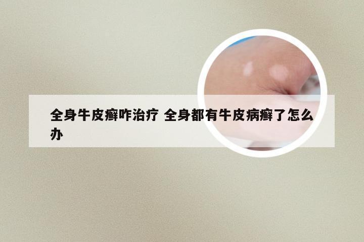 全身牛皮癣咋治疗 全身都有牛皮病癣了怎么办