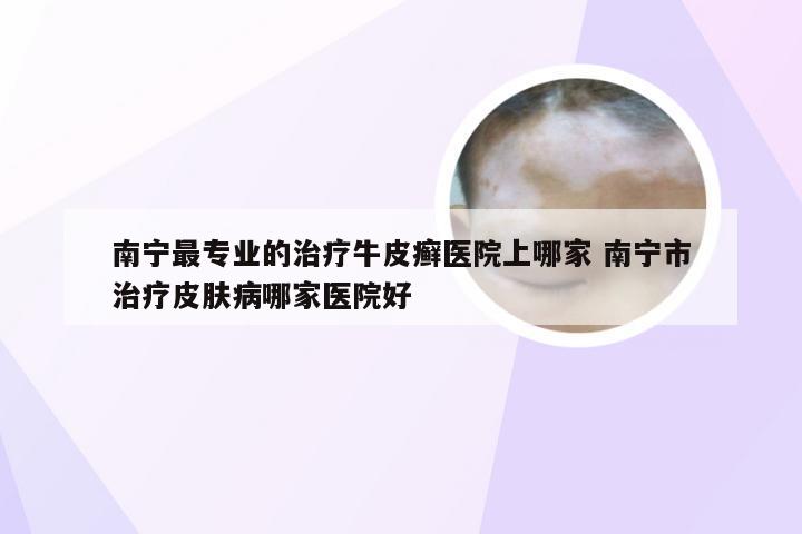 南宁最专业的治疗牛皮癣医院上哪家 南宁市治疗皮肤病哪家医院好