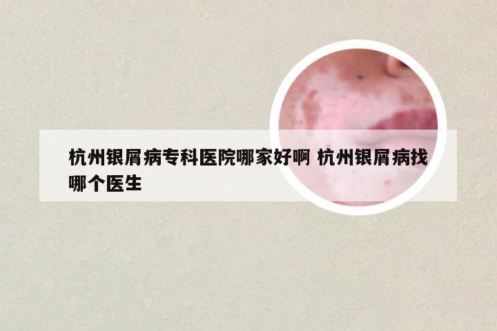 杭州银屑病专科医院哪家好啊 杭州银屑病找哪个医生