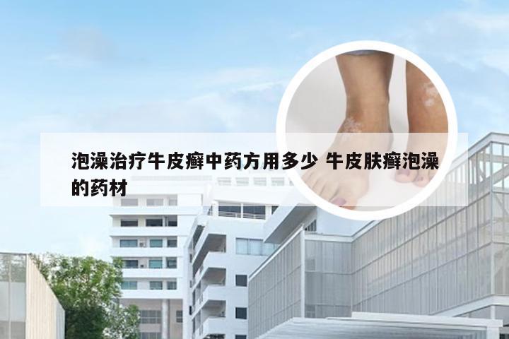 泡澡治疗牛皮癣中药方用多少 牛皮肤癣泡澡的药材