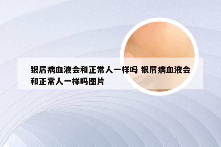 银屑病血液会和正常人一样吗 银屑病血液会和正常人一样吗图片