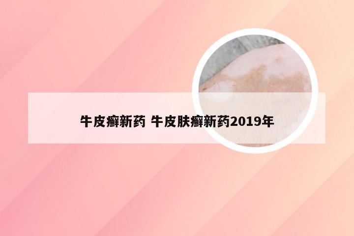 牛皮癣新药 牛皮肤癣新药2019年