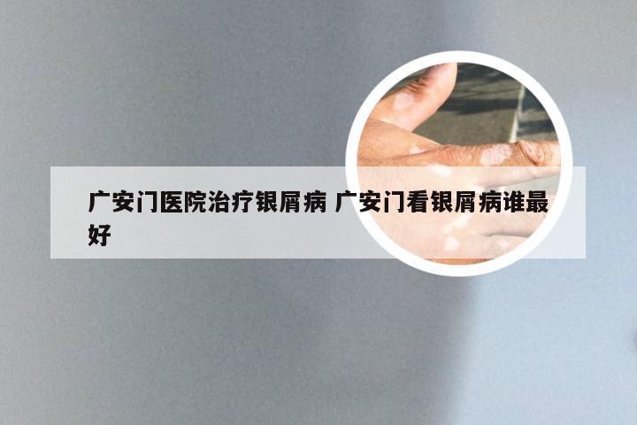 广安门医院治疗银屑病 广安门看银屑病谁最好
