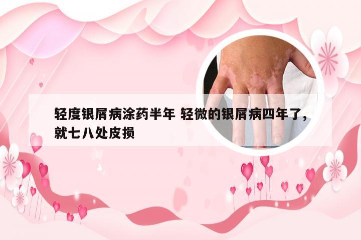 轻度银屑病涂药半年 轻微的银屑病四年了,就七八处皮损