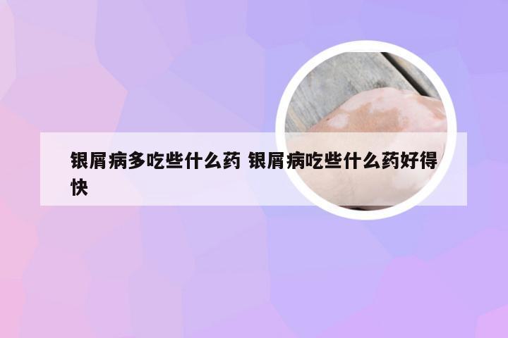 银屑病多吃些什么药 银屑病吃些什么药好得快